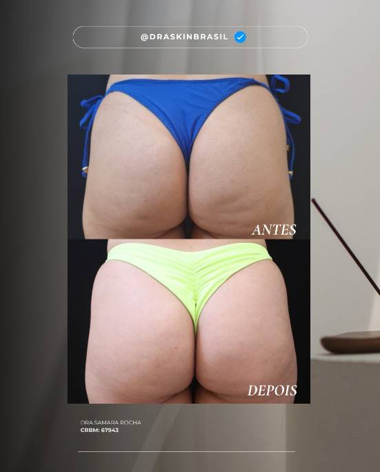 tratamento lipedema